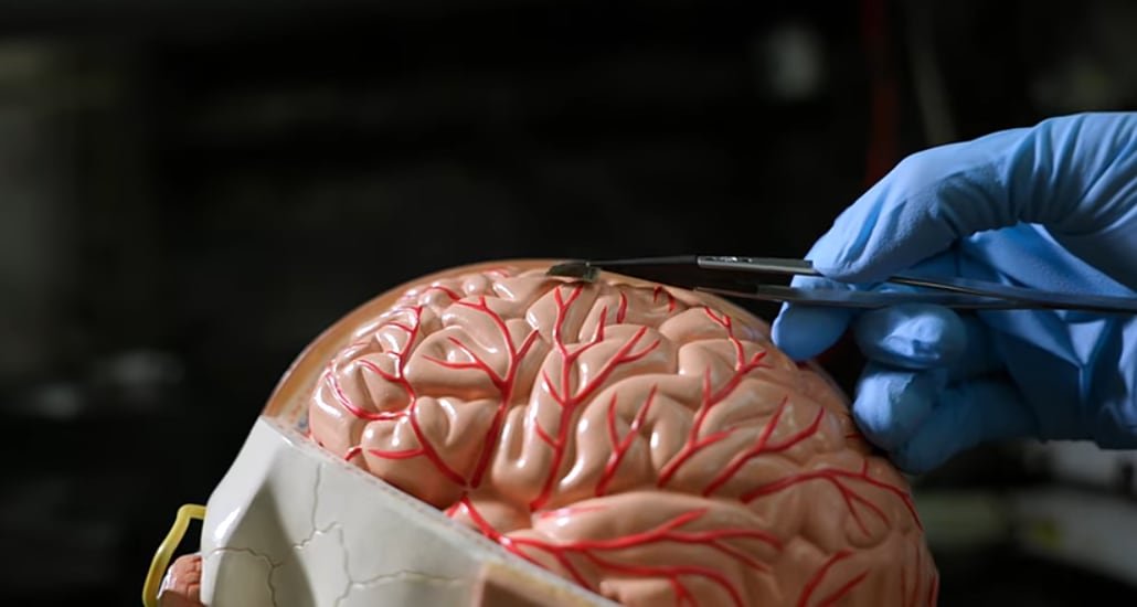 El chip ultradelgado va colocado entre el cráneo y el cerebro.