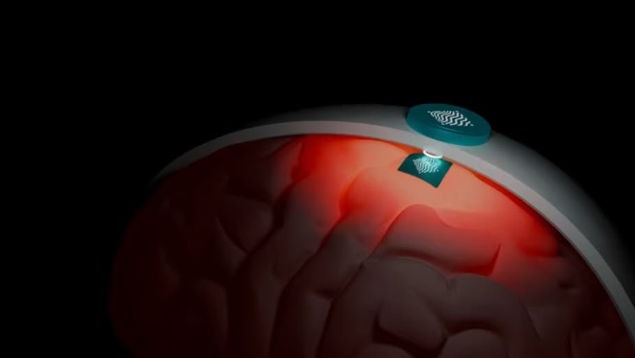 El chip ultradelgado permite que su implementación en el cerebro sea minimamente invasiva.