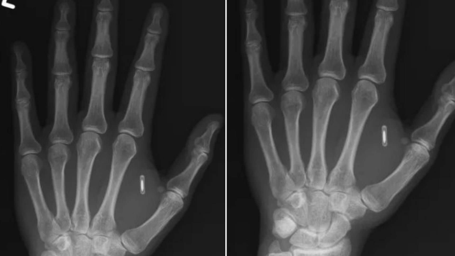 Radiografía de la mano del mago, donde se observa el perfil blanco del microchip incrustado entre el pulgar y el índice.