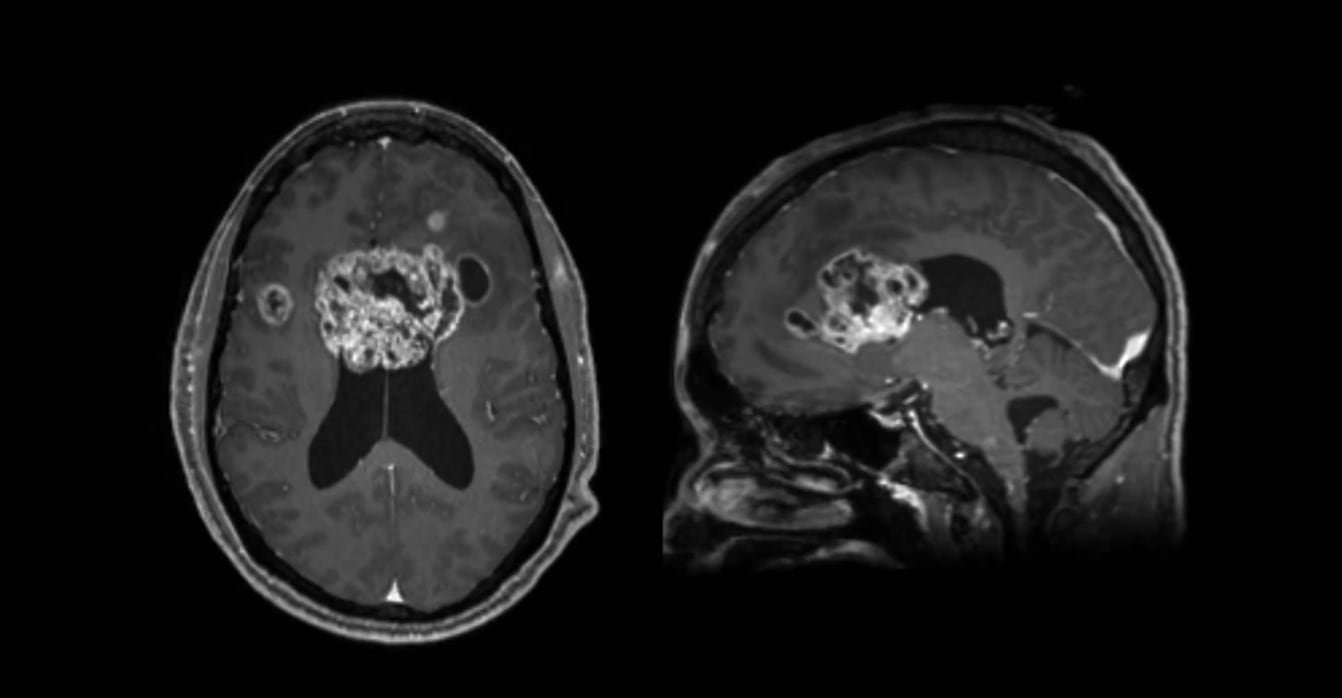 La tomografía que detectó el tumor cerebral de Jason Collins (captura video)