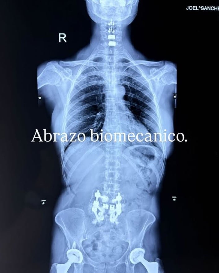Alejandra Guzmán compartió en Instagram la radiografía de su columna y cadera tras cirugía de emergencia (IG)