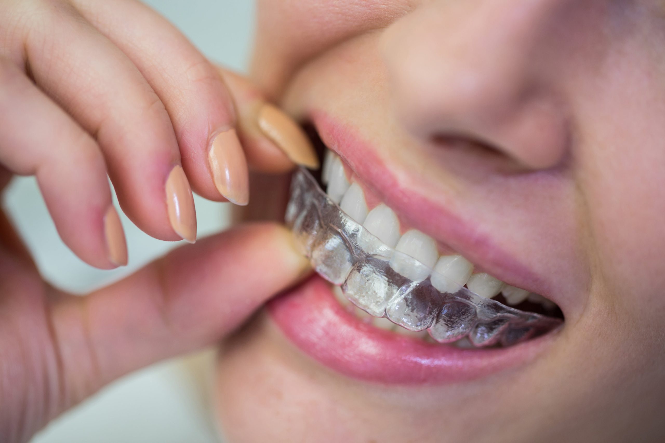 Las férulas dentales personalizadas se utilizan para proteger el esmalte dental, reducir la sobrecarga mandibular y aliviar la tensión por bruxismo (Crédito: Freepik)