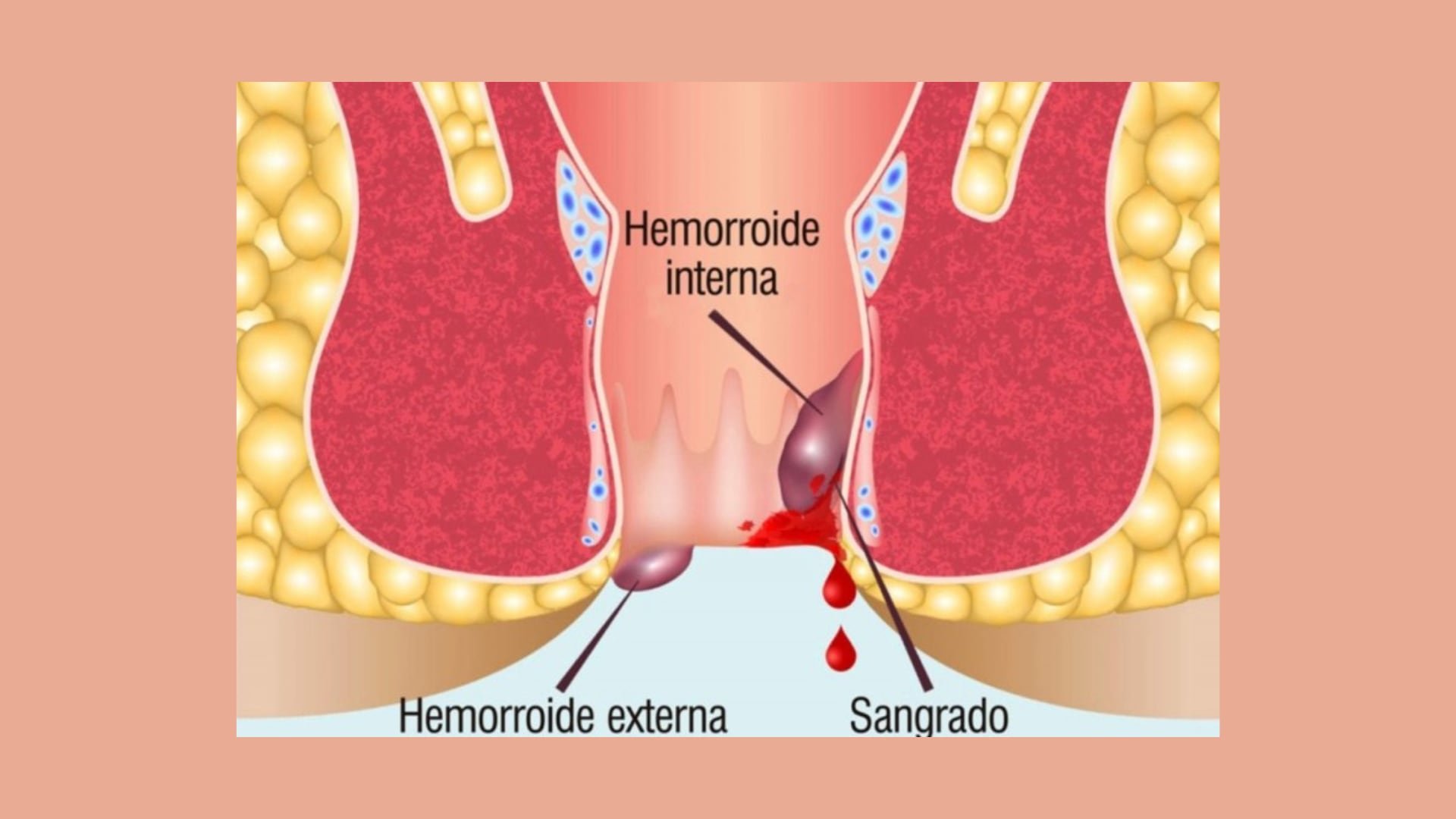 Las hemorroides internas se desarrollan dentro del recto y las hemorroides externas se forman debajo de la piel que rodea el ano (Pharmacius)