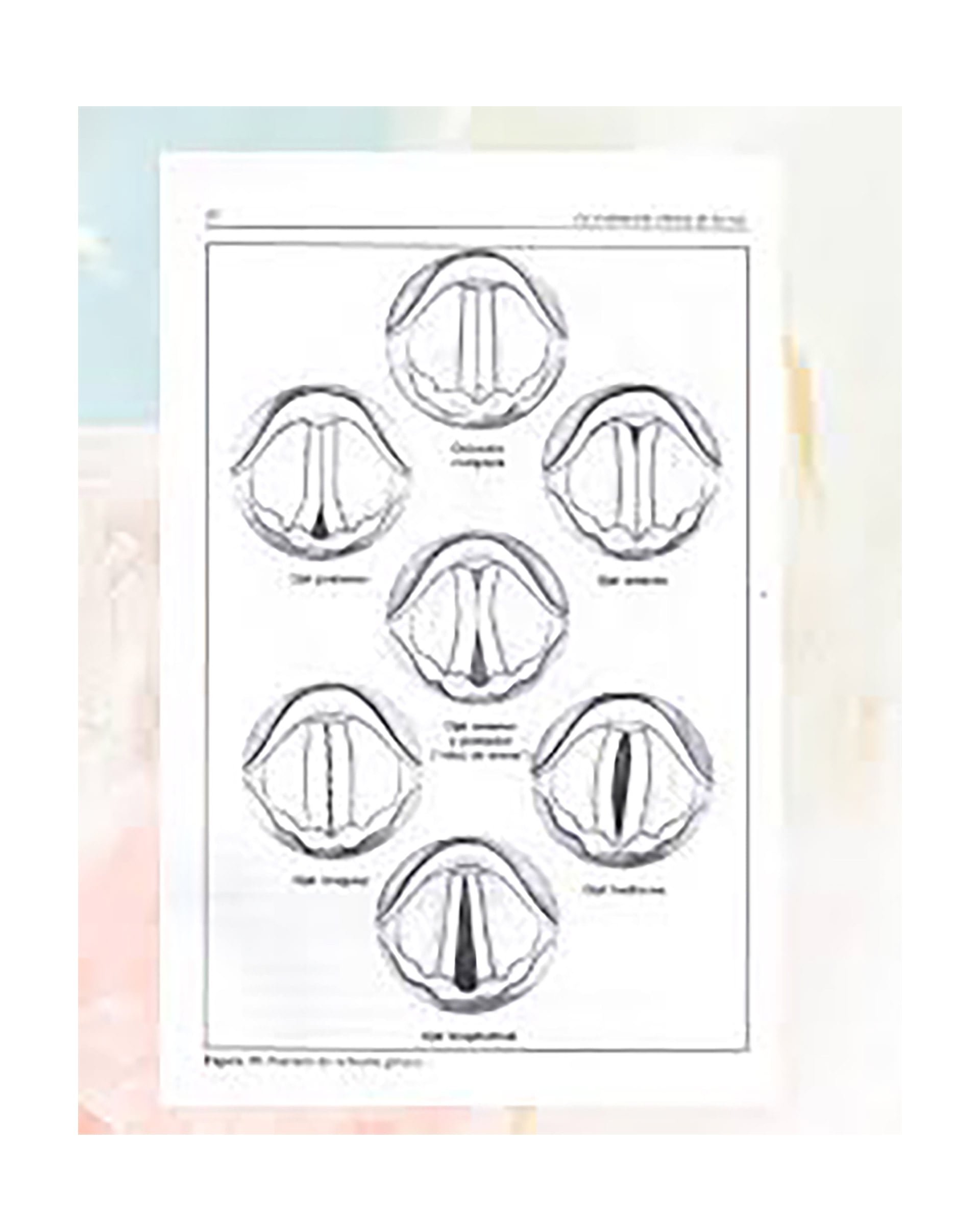 Esquemas de los hiatus que se forman en la laringe: las cuerdas vocales no se cierran correctamente durante la emisión de la voz