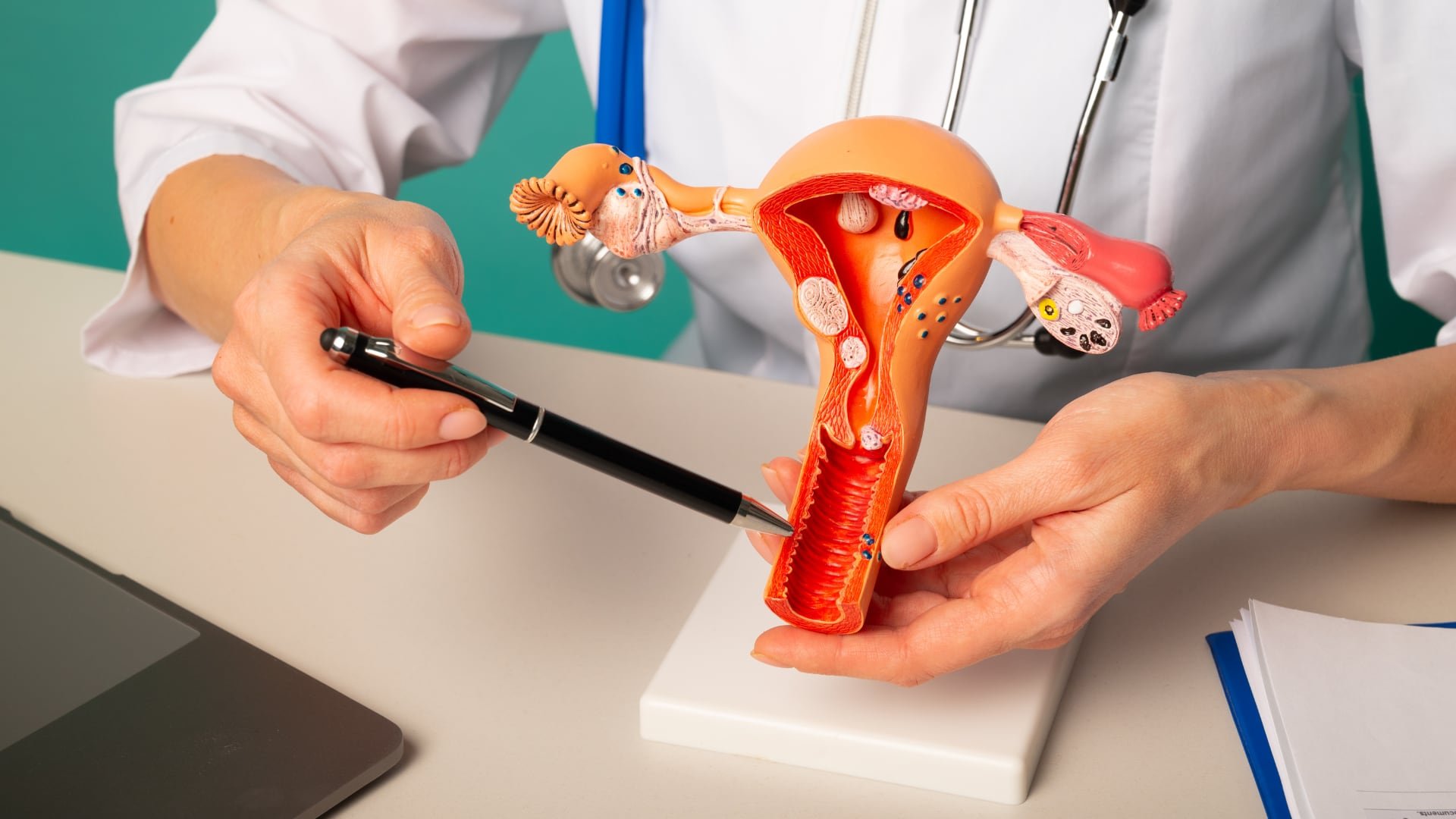 Pólipos y fibromas uterinos figuran entre las causas benignas más frecuentes de sangrado después de la menopausia, junto con la atrofia vaginal (Canva)