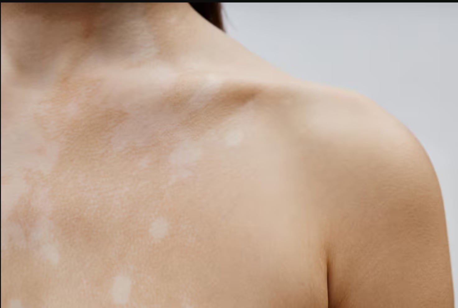 El cultivo dermo-epidérmico autólogo permite una mayor elasticidad y mejor integración del tejido en quemaduras complejas (Freepik)