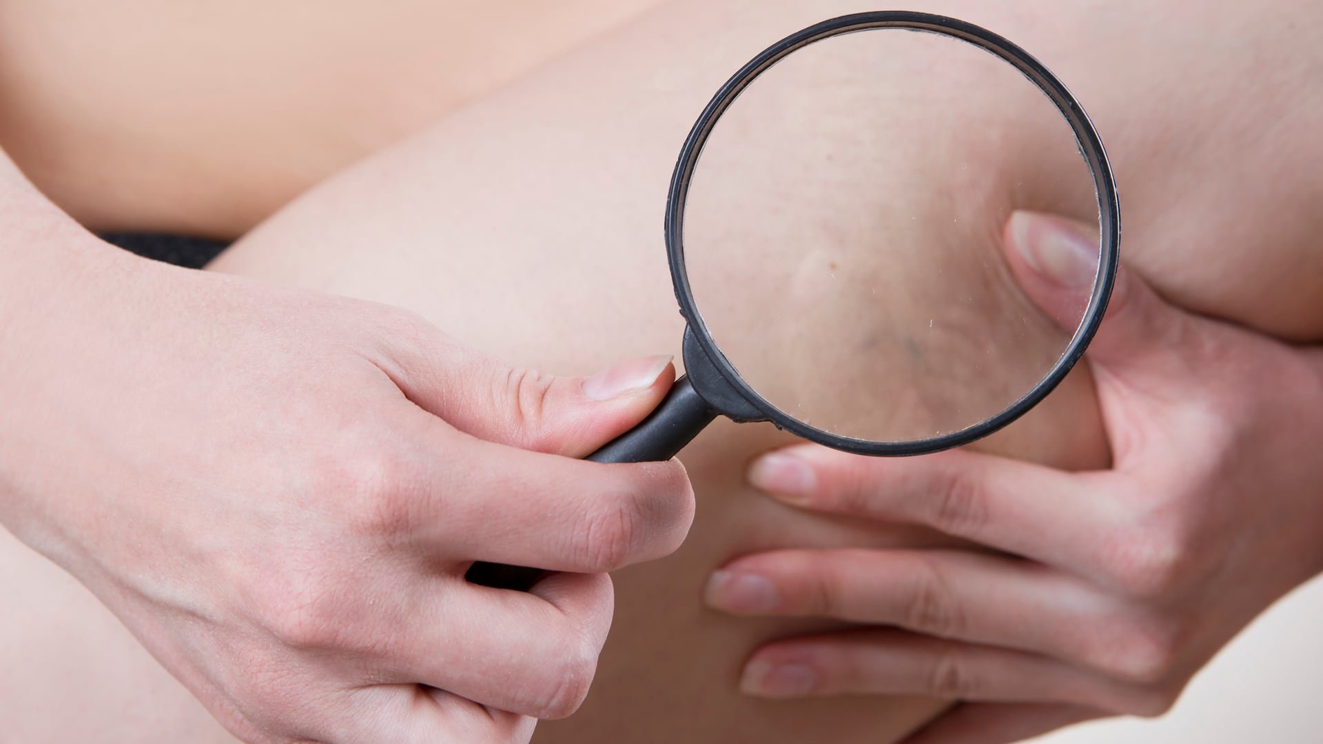 Mujer buscando huellas de la celulitis (iStock)