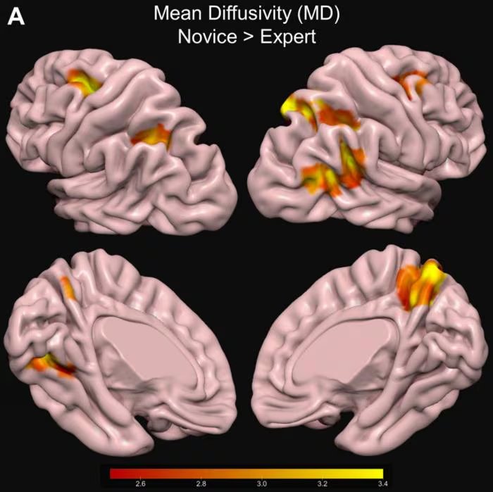 Se muestran las regiones corticales del cerebro con menor difusividad media (DM) en expertos en comparación con principiantes. Una DM más baja implica una estructura cerebral más compacta. La barra de color indica los valores t (Erik
Wing)