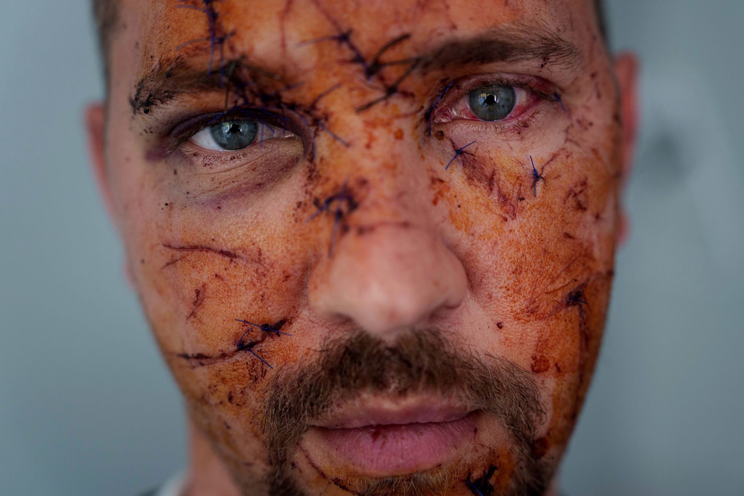 Múltiples heridas son visibles en el rostro de Kostiantyn Bychek durante una visita hospitalaria en Kiev, Ucrania, el 25 de abril de 2025. Resultó herido en un ataque ruso (AP/Evgeniy Maloletka, Archivo)