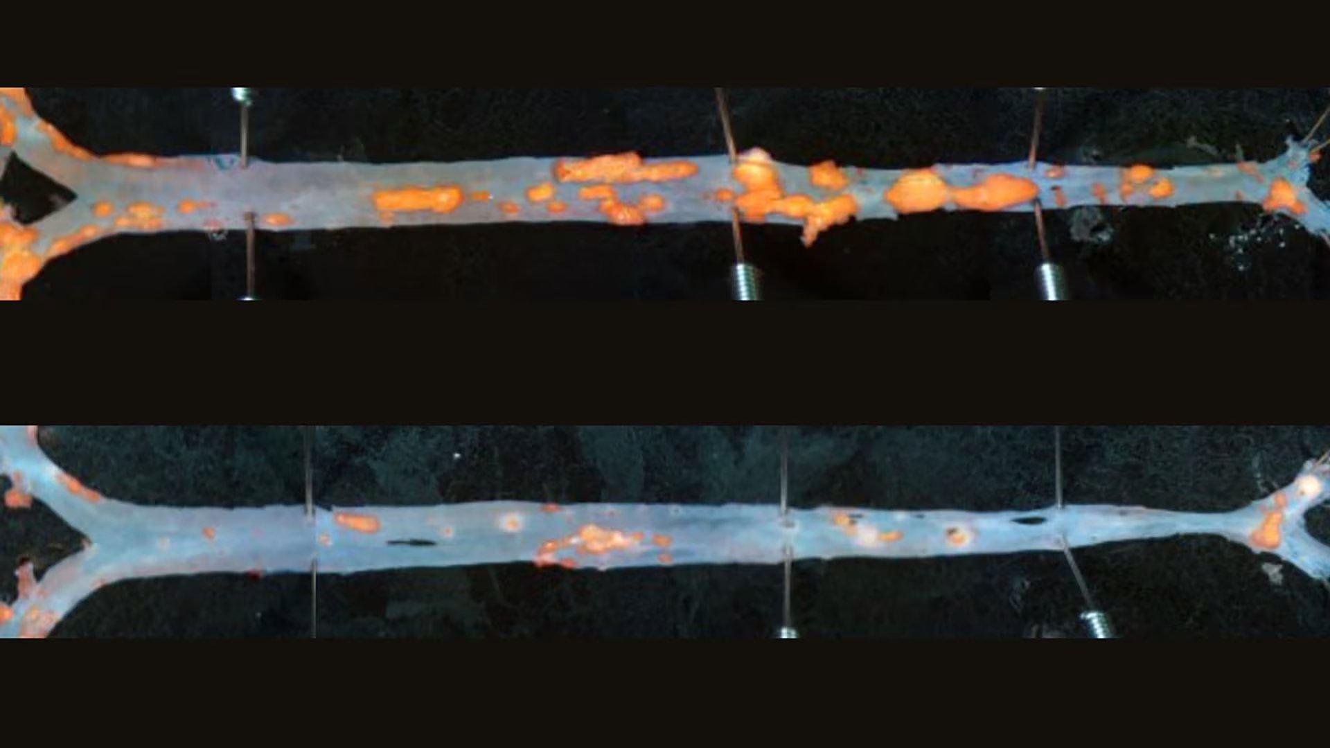 La arteria de un ratón sin tratar muestra más placa que la de un ratón que recibió la inmunoterapia con anticuerpos (Junedh Amrute)