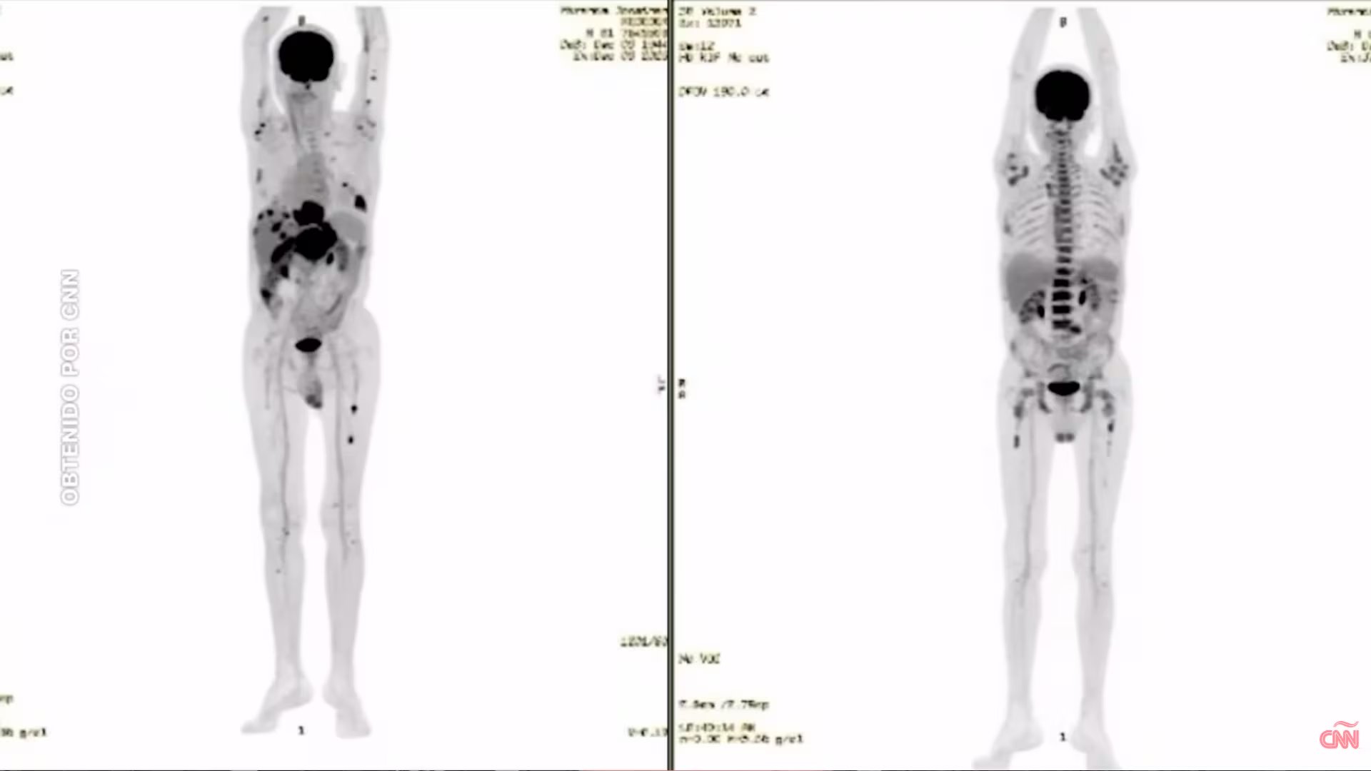 De metástasis en todo el cuerpo a remisión casi total en cuatro semanas
