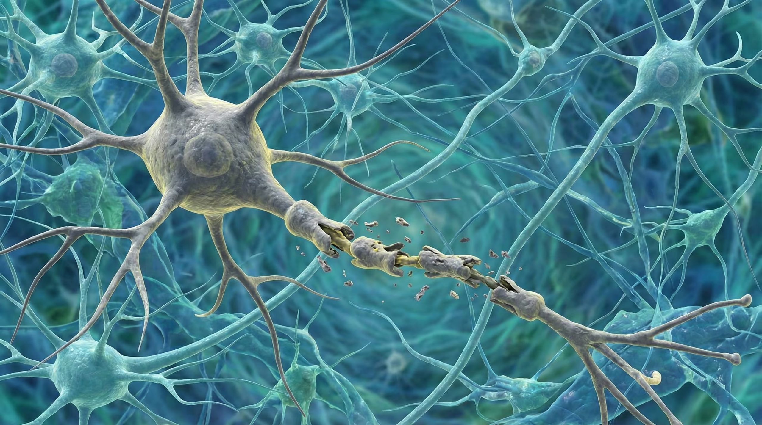 El aumento de los niveles sanguíneos de neurofilamento de cadena ligera está asociado al paso de los años y al deterioro neuronal (Imagen Ilustrativa Infobae)
