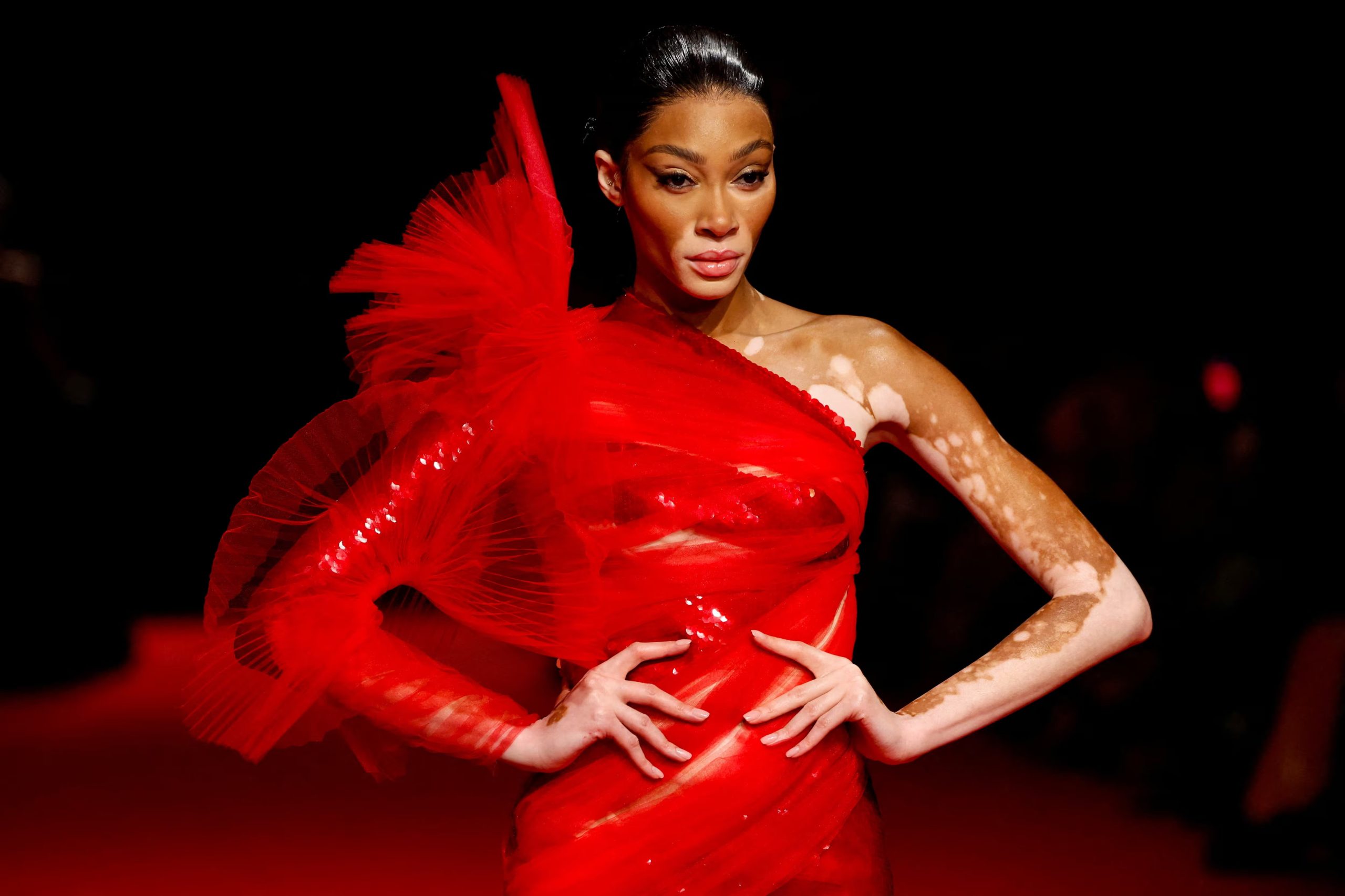 Su vitiligo y autenticidad han inspirado campañas sobre aceptación y representación real en las pasarelas