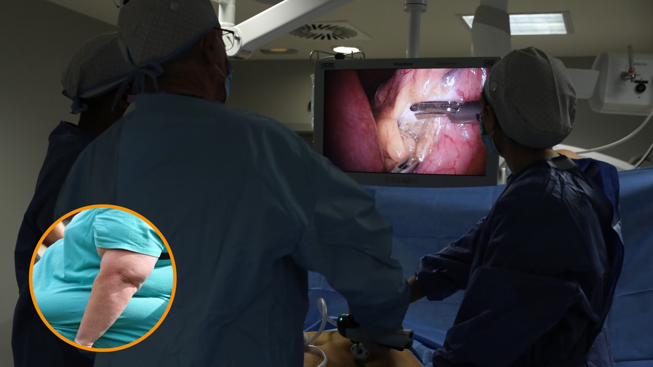 Operación de bypass gástrico.