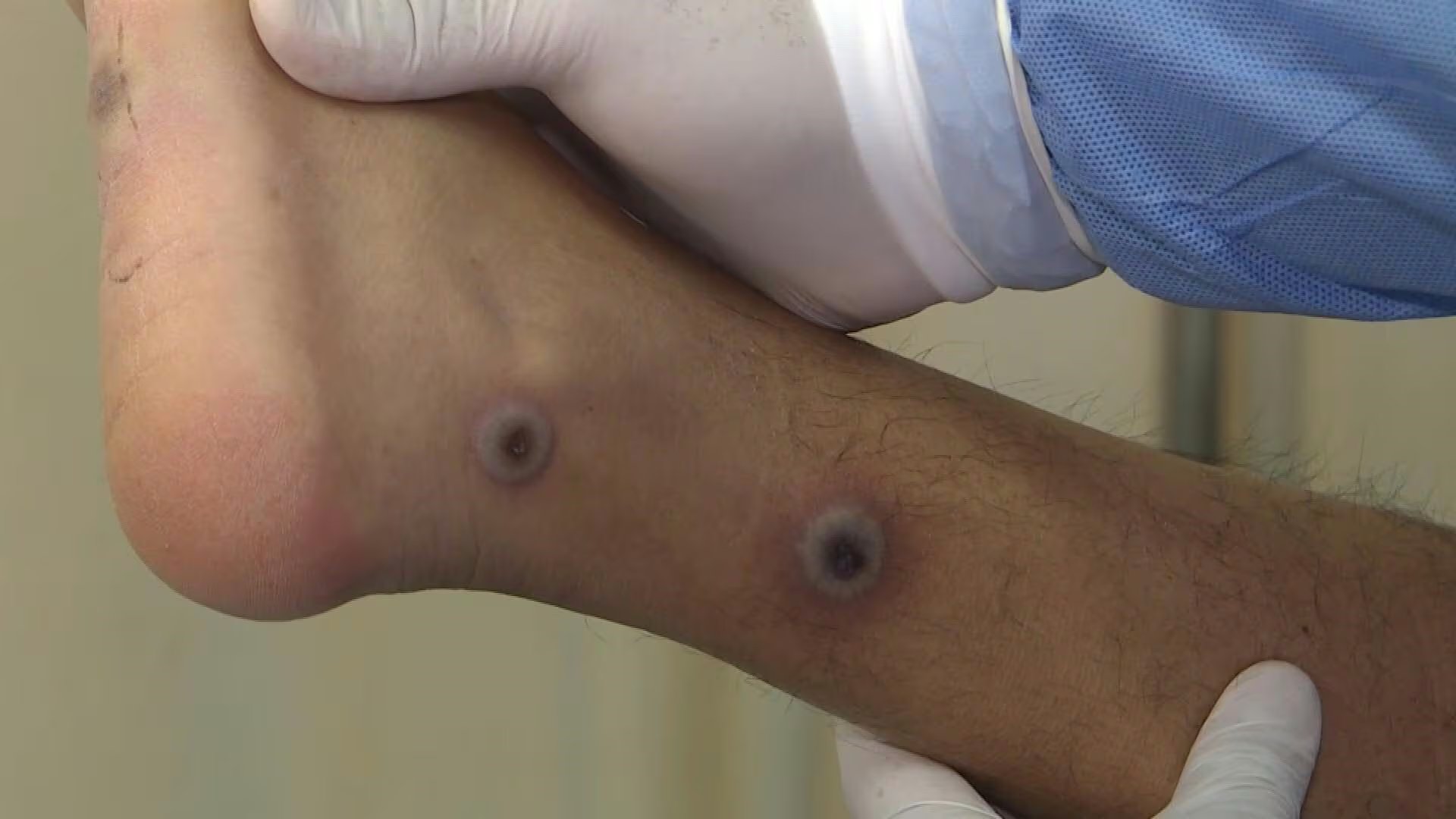 La región de América se ha convertido en el epicentro del brote de viruela del mono, con la mayor cantidad de casos en el mundo, alertó el miércoles la Organización Panamericana de la Salud (OPS).