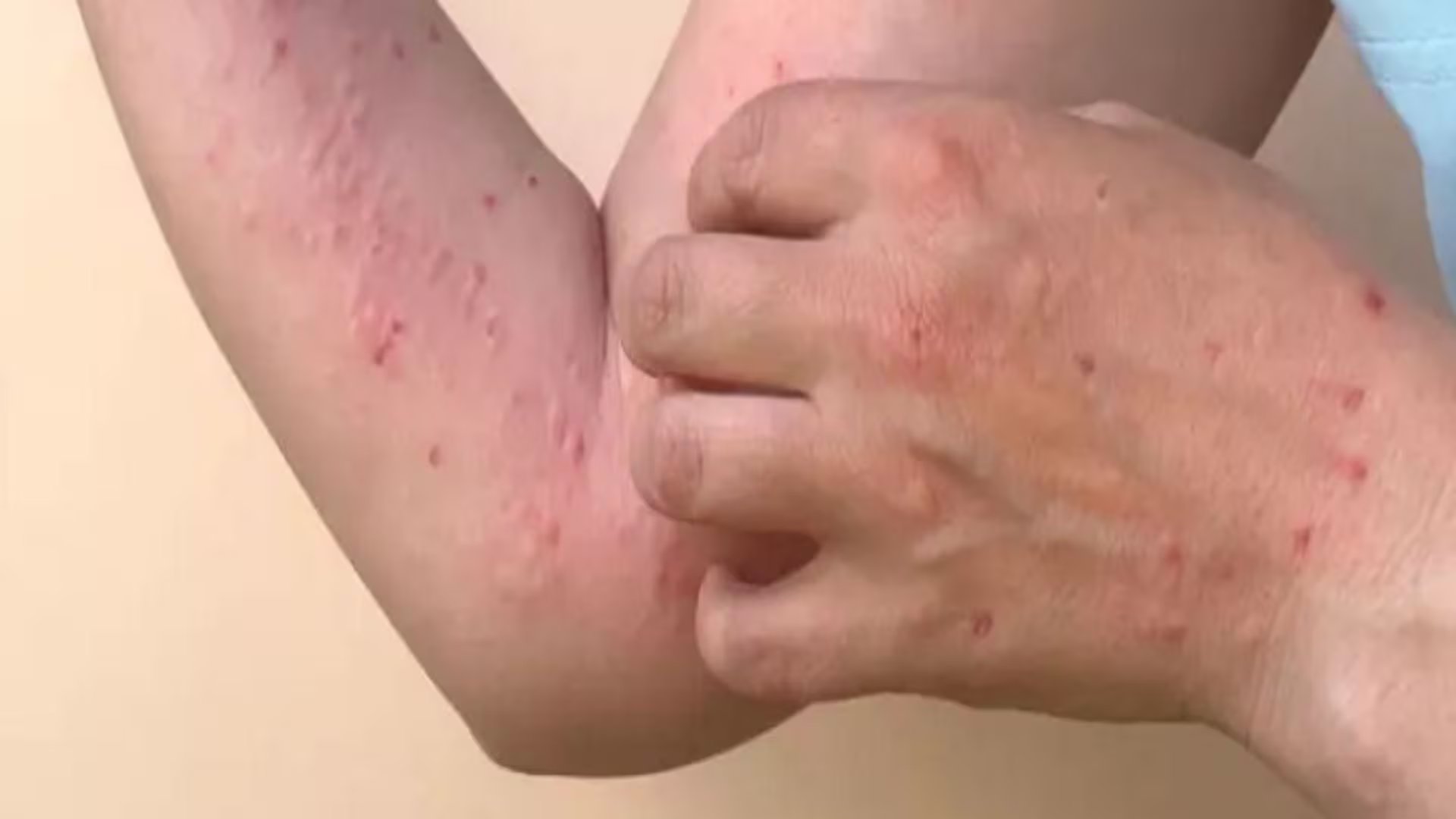 Fiebre, dolores musculares, fatiga, dolor de cabeza e inflamación de ganglios linfáticos se presentan entre los síntomas frecuentes de la Mpox. (Freepik)
