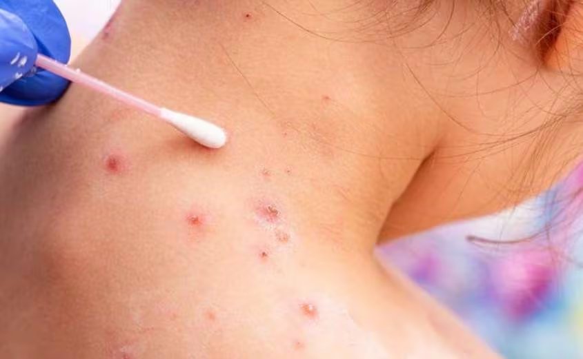 Las erupciones cutáneas, ampollas y llagas son los signos más visibles de la viruela del mono y pueden localizarse en distintas partes del cuerpo (Freepik)
