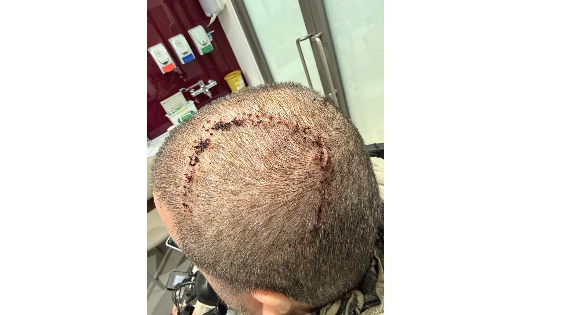 El propio Noble señaló que la cirugía inicial fue sencilla: bajo anestesia y mediante una incisión mínima, un robot implantó 1.024 hilos ultrafinos en su corteza motora. (X: CheckCanopy)