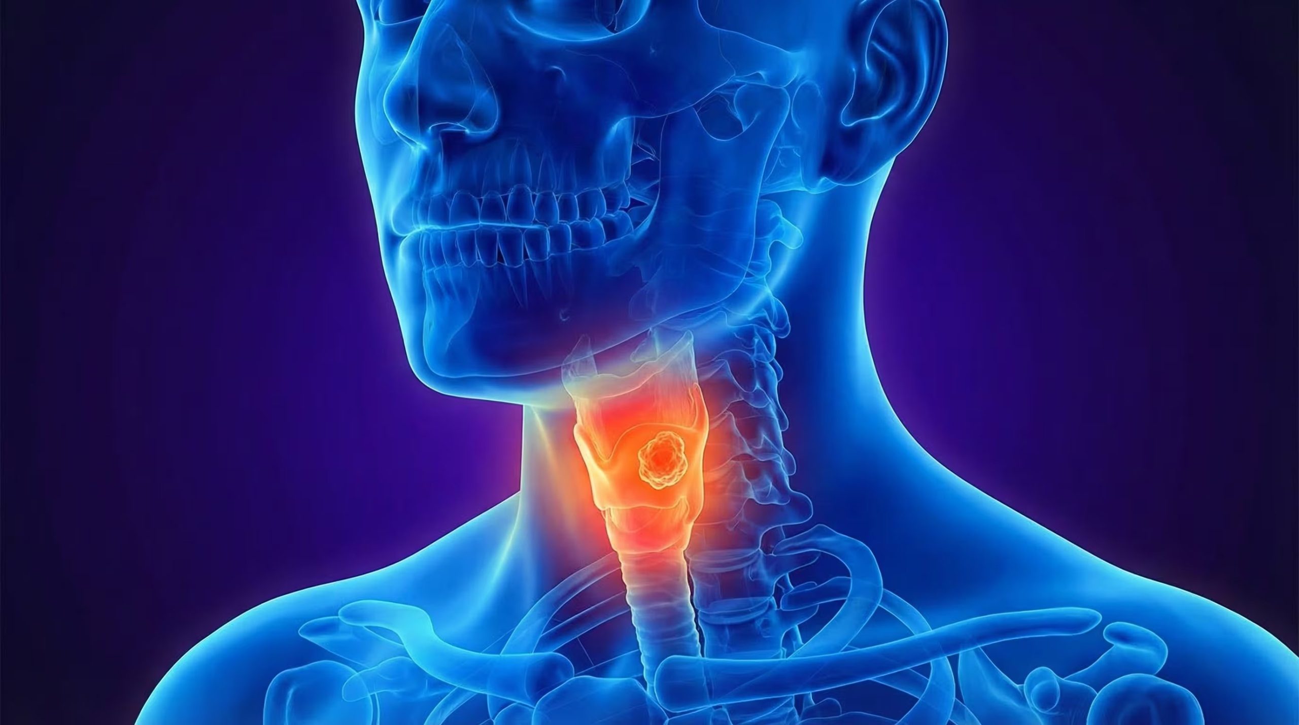 El cáncer de laringe enfrenta retos médicos debido al impacto del tumor en el movimiento de las cuerdas vocales
(Imagen Ilustrativa Infobae)