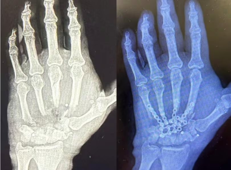 Radiografías muestran la exitosa reconstrucción de una mano severamente lesionada, realizada por el ISSSTE en un paciente que recuperó movilidad. (ISSSTE)