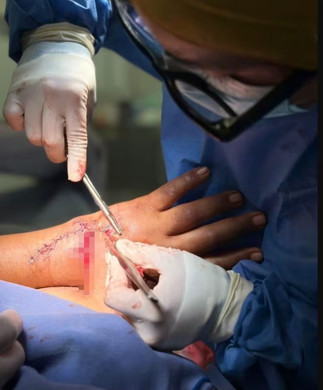Un equipo de especialistas del ISSSTE realiza una compleja cirugía reconstructiva de mano y antebrazo para un paciente de Guerrero, logrando recuperar la movilidad y circulación. (ISSSTE)