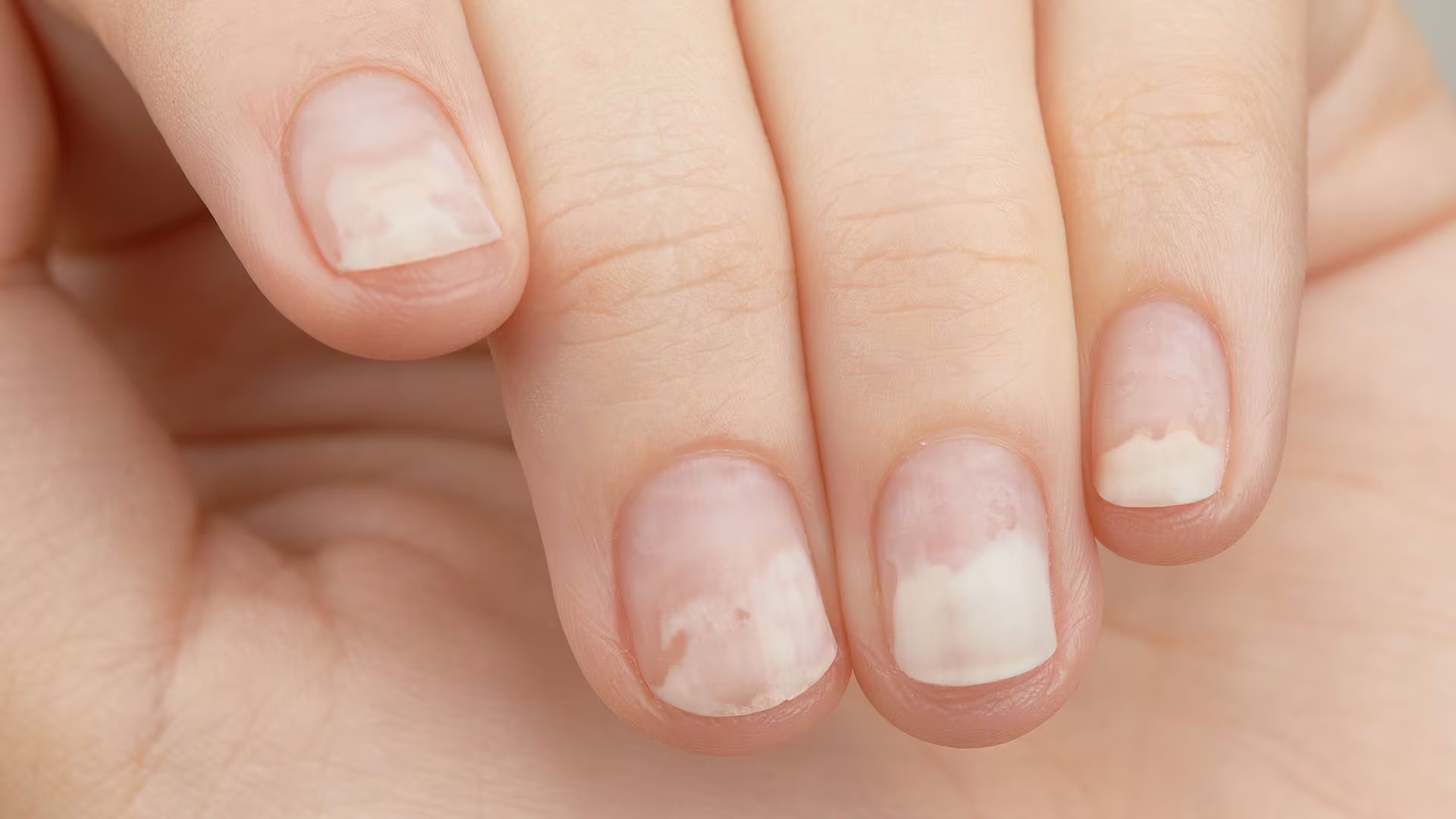 Las manchas blancas en las uñas, conocidas como leuconiquia, no están relacionadas con la falta de calcio como se suele creer (Freepik)
