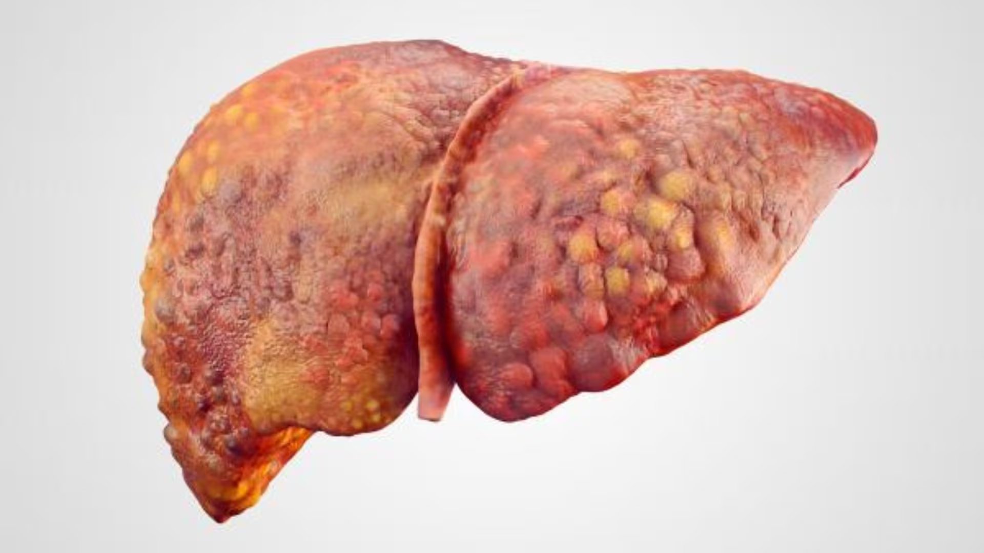 La dieta mediterránea se asocia a una reducción significativa del riesgo de hígado graso no alcohólico, según The New England Journal of Medicine.
(RS)