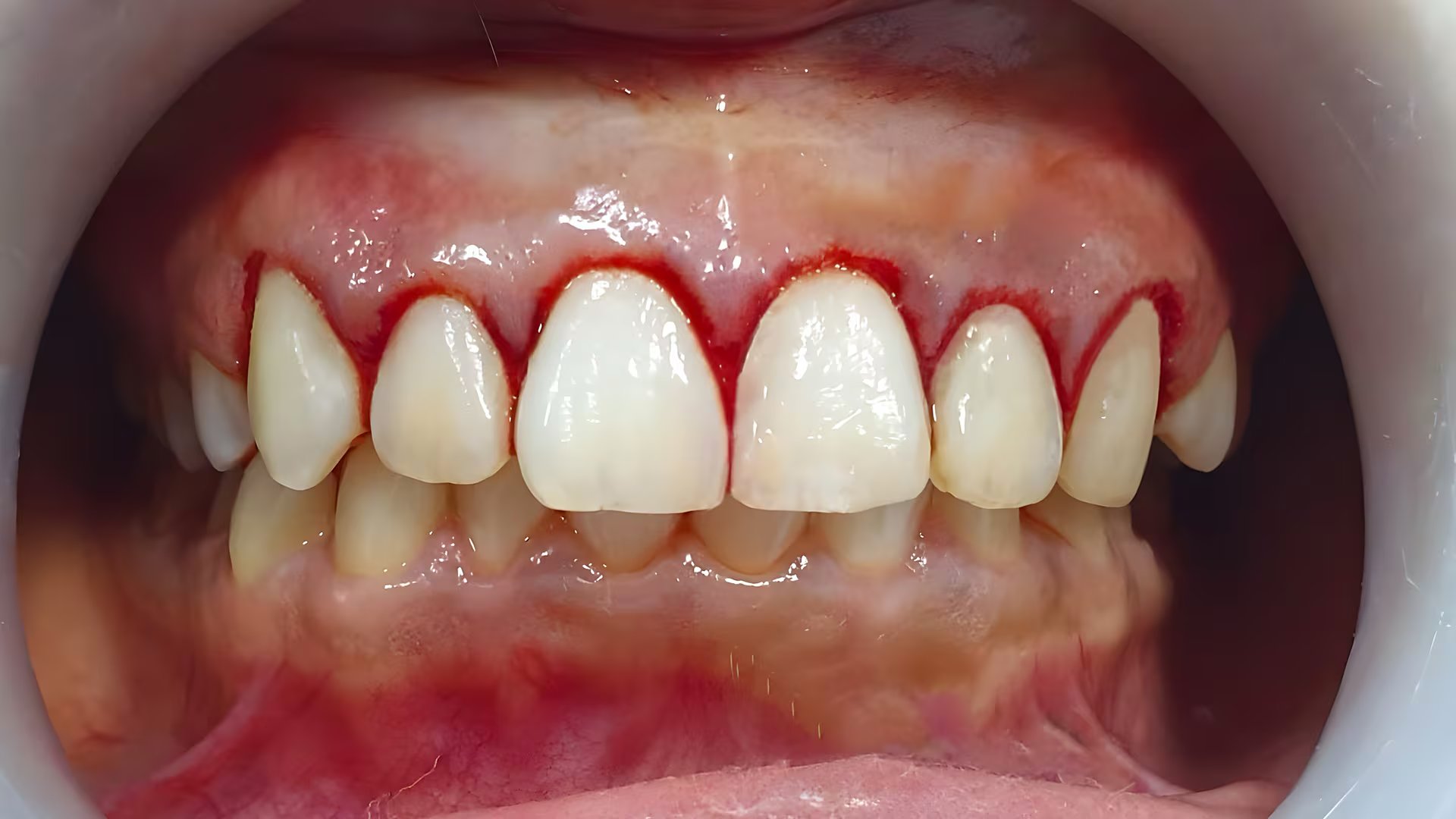 La enfermedad periodontal incrementa la inflamación general del organismo y eleva el riesgo cardiovascular y metabólico (Freepik)