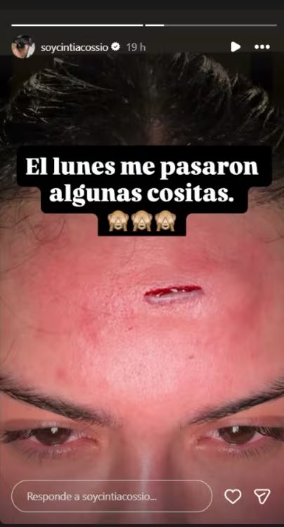 Cintia Cossio montró la lesión que se hizo y generó preocupación - crédito @soycintiacossio/IG