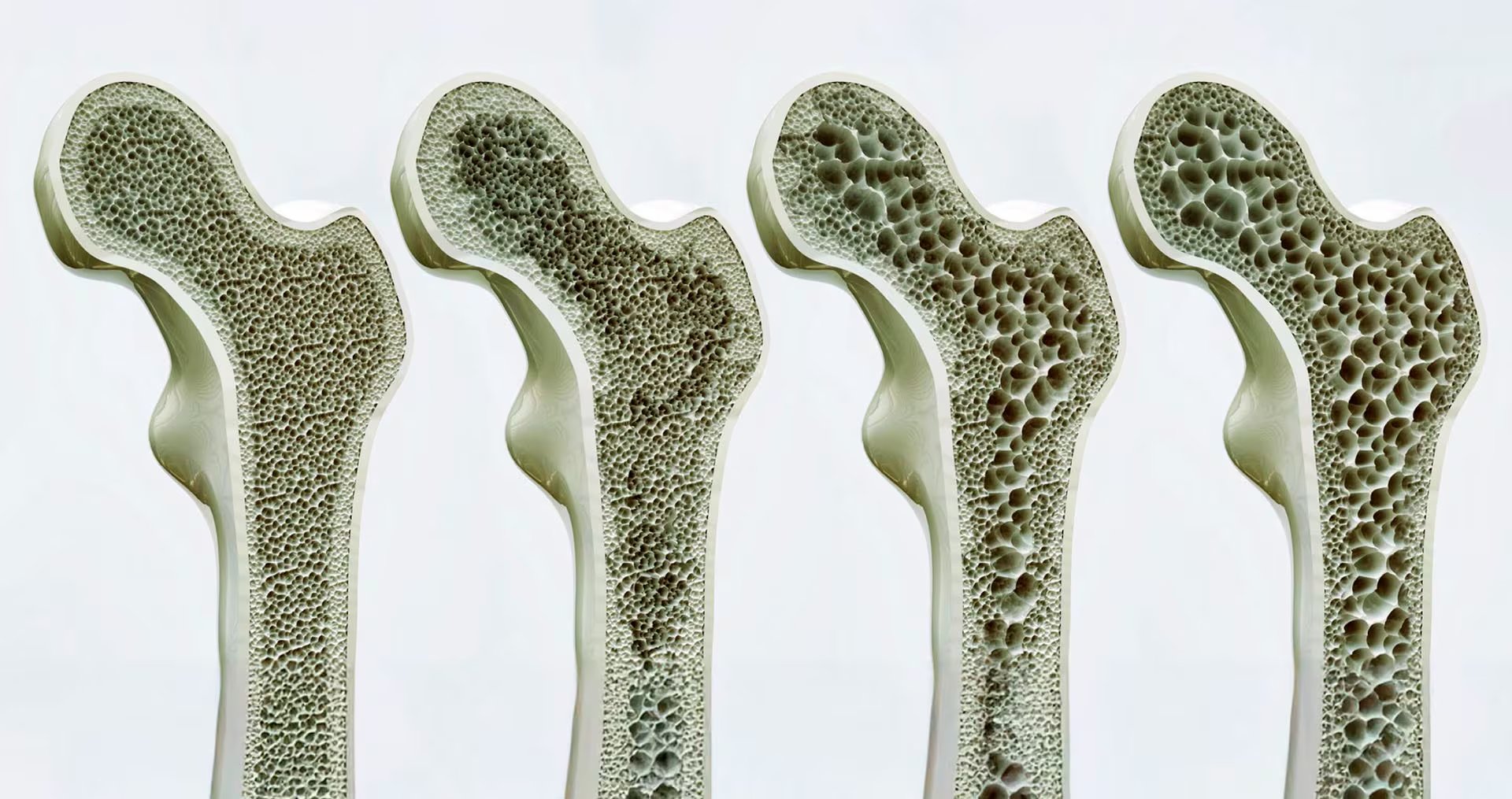 El gen APOE4, vinculado al riesgo de Alzheimer, impacta la calidad del hueso en hembras de ratón mucho antes de que surjan síntomas cerebrales