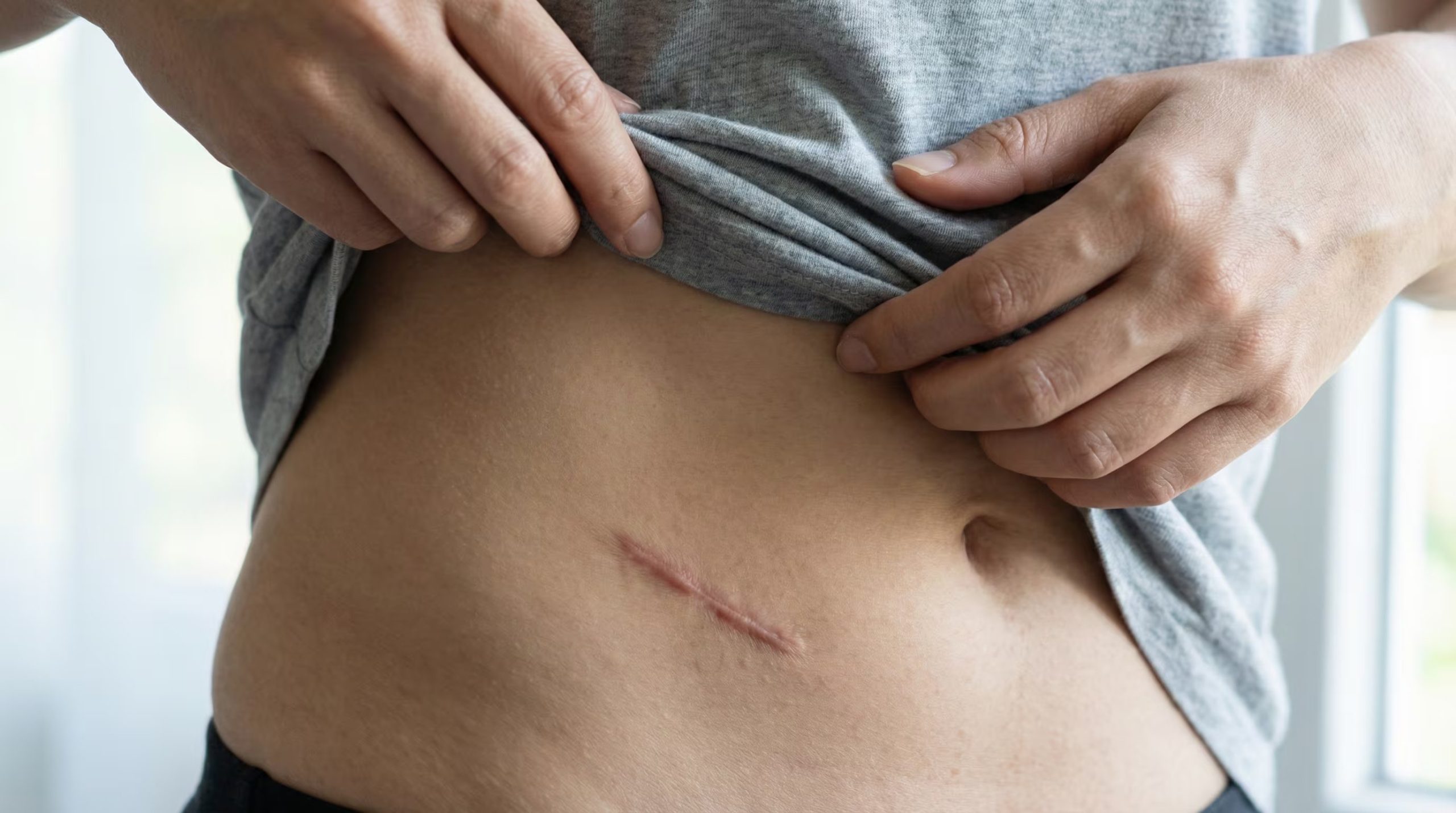 La mayoría de las personas puede vivir sin apéndice porque el cuerpo compensa su ausencia mediante otros mecanismos inmunológicos (Imagen Ilustrativa Infobae)