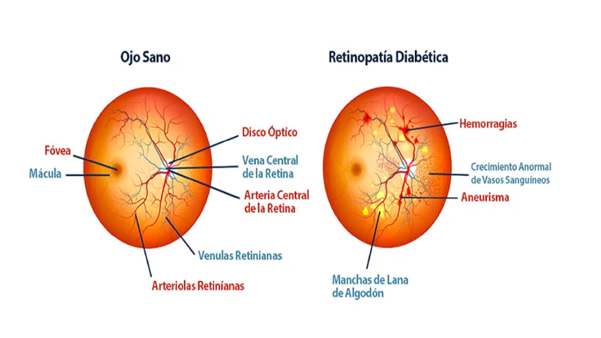 gotas oftálmicas retinopatía diabética UNAM avance