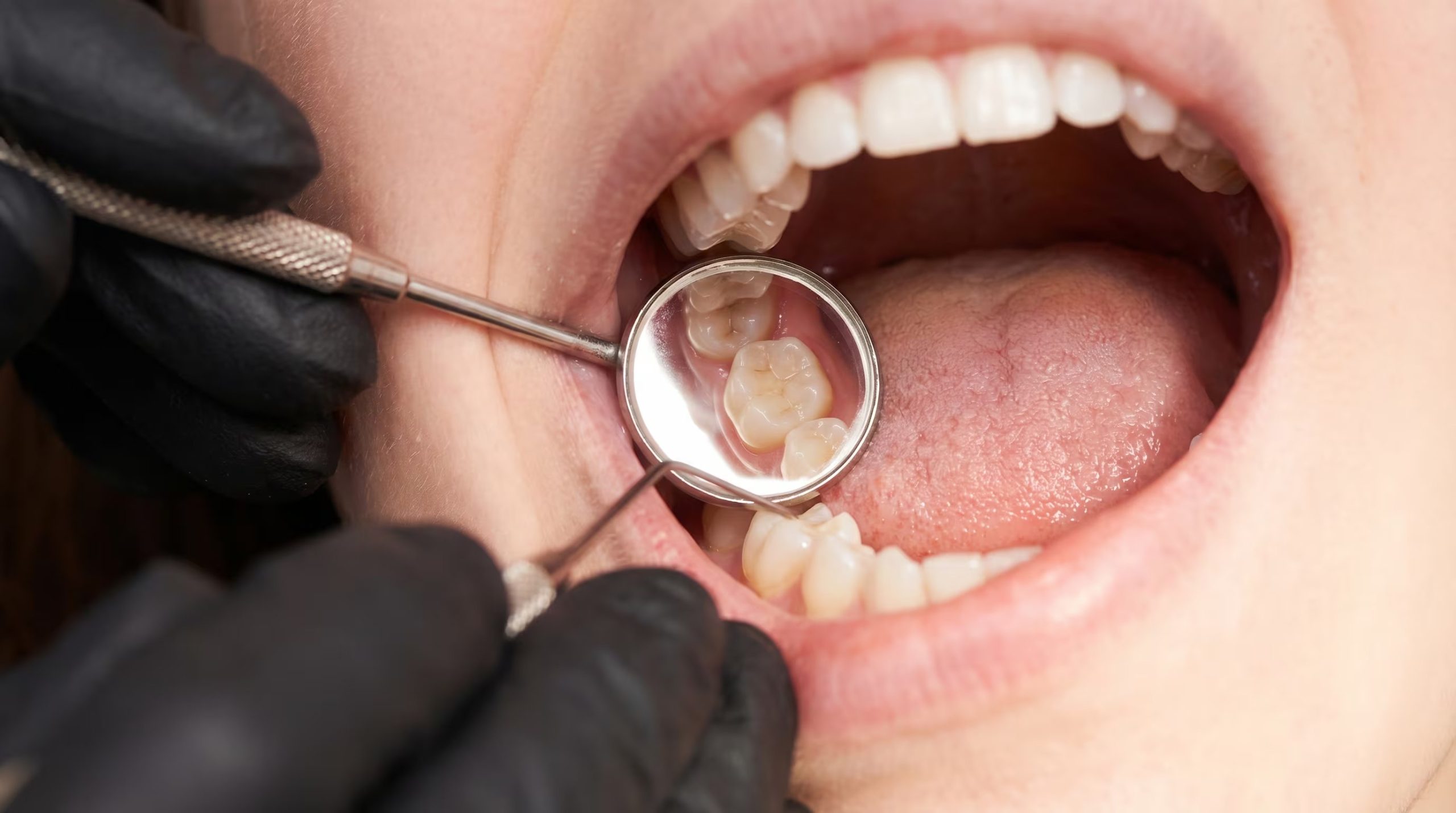 La estructura craneofacial humana se transformó por el aumento del cerebro, generando problemas de espacio para los terceros molares en la arcada dental (Imagen Ilustrativa Infobae)