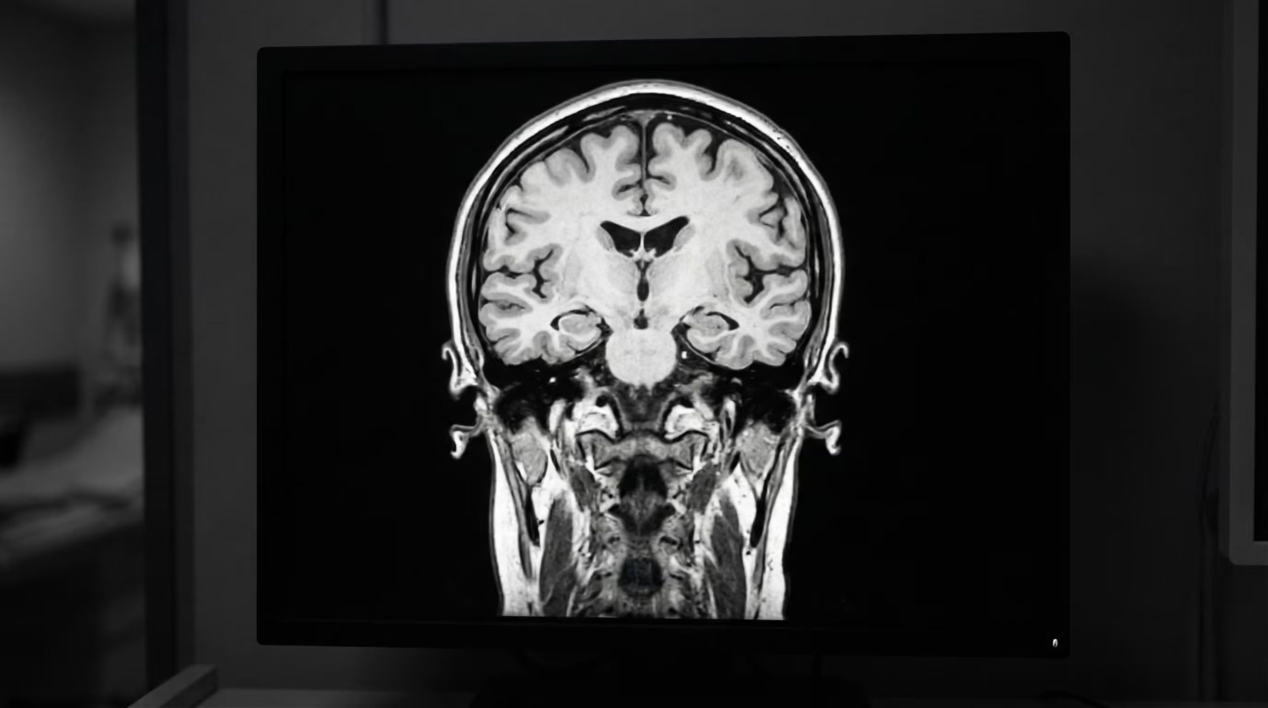 La acumulación de compuestos tóxicos en el cerebro es consecuencia de fallas en los mecanismos celulares del sistema nervioso por el síndrome de Sanfilippo
(Imagen Ilustrativa Infobae)