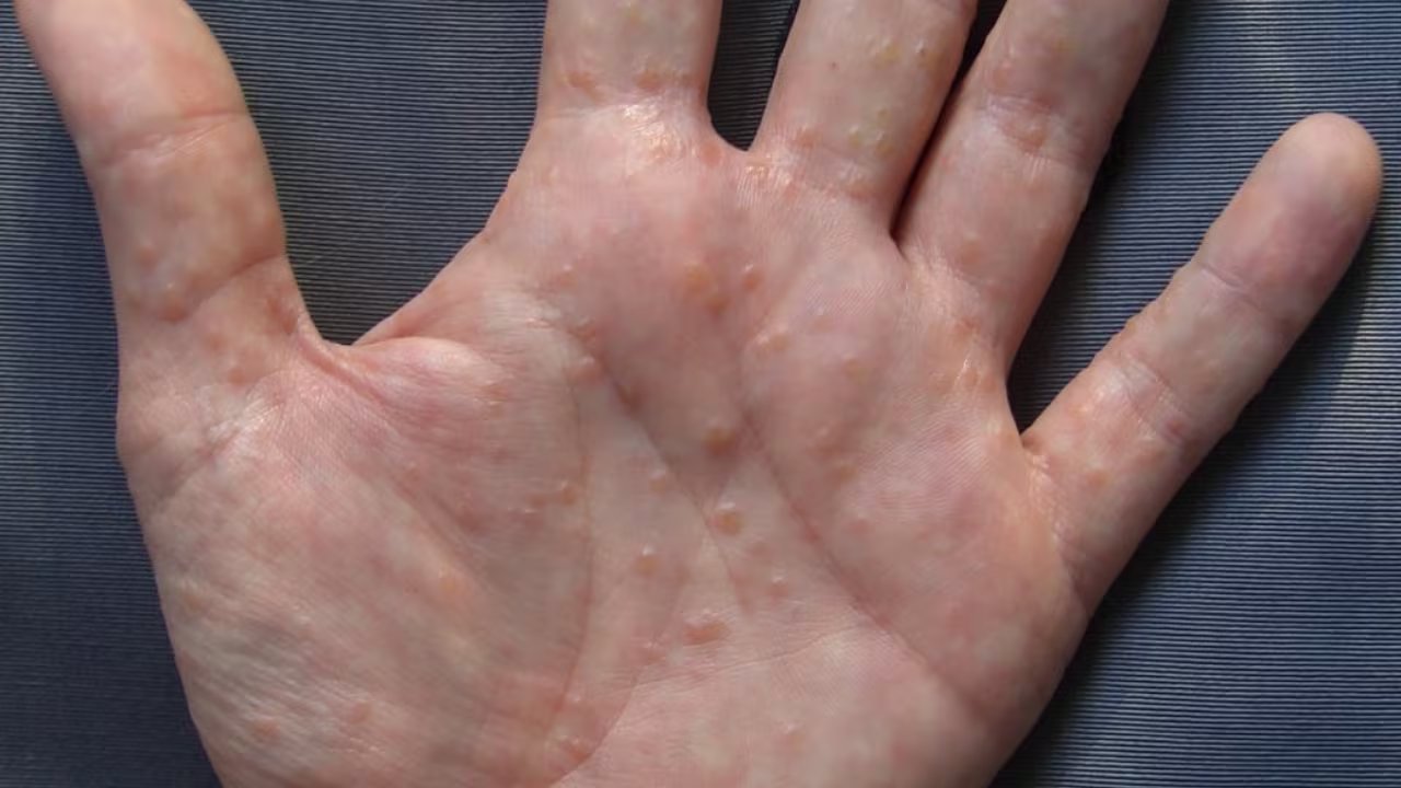 La dishidrosis se presenta como ampollas llenas de líquido en la palma de la mano y entre los dedos. (Wikimedia Commons)