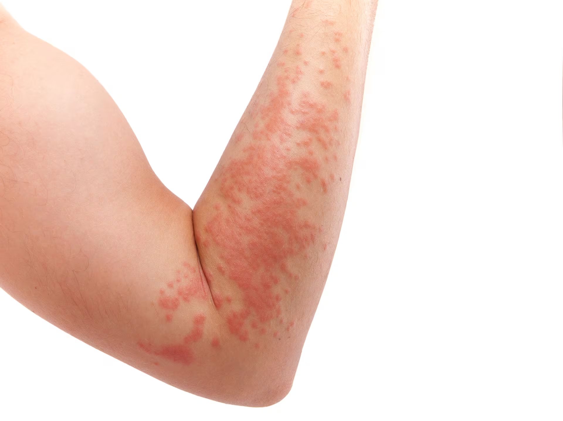 Los síntomas de urticaria acuagénica pueden desencadenarse incluso por sudoración, aunque esto no afecta a todos los pacientes diagnosticados (gokhanilgaz)