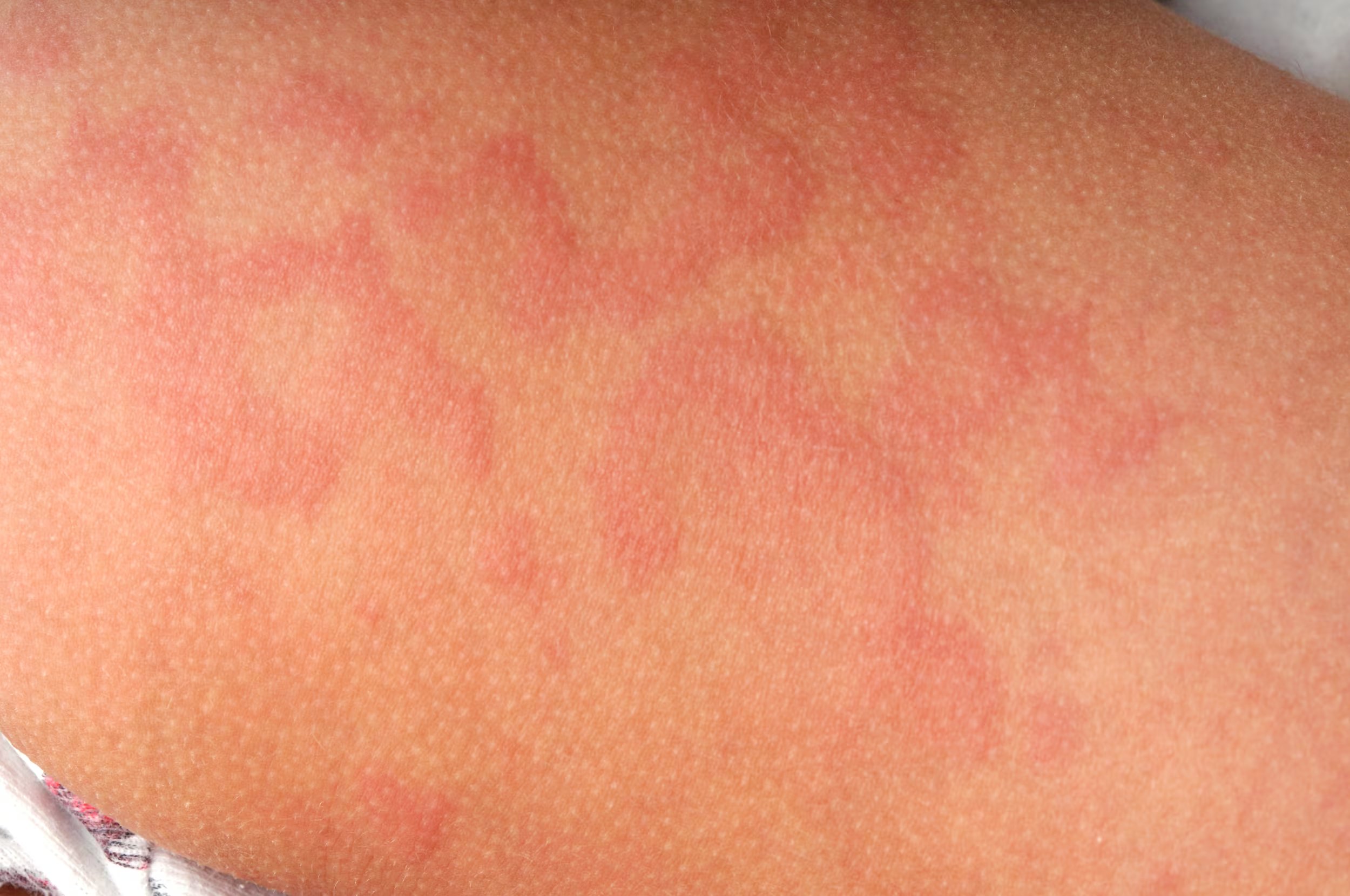 El uso de antihistamínicos y medicamentos recientes como omalizumab ofrece alivio sintomático para quienes padecen urticaria acuagénica, aunque no existe cura definitiva