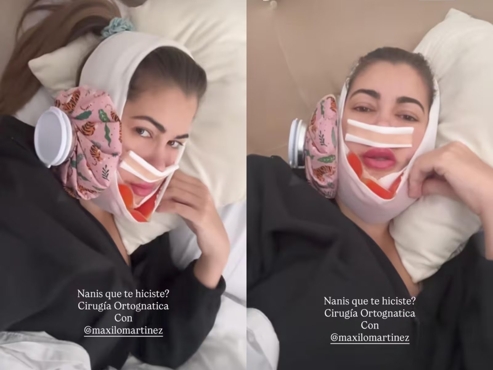 Nanis Ochoa explicó que la cirugía ortognática mejora la simetría facial y funciones vitales como la masticación y la respiración - crédito nanis8a / Instagram