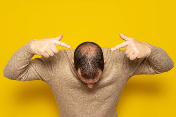 Los investigadores señalaron que la desoxirribosa mostró una eficacia comparable al minoxidil, pero advirtieron que aún faltan estudios para confirmar su seguridad y eficacia en humanos (crédito iStock)