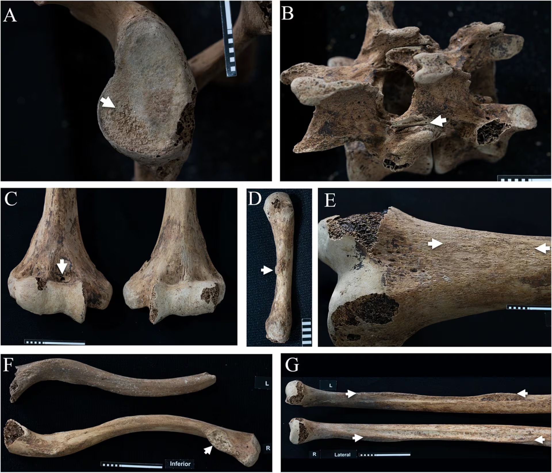 Los huesos de la princesa Ita registran lesiones articulares y marcas musculares que revelan una vida físicamente exigente hace más de tres mil setecientos años (Frontiers in Environmental Archaeology)