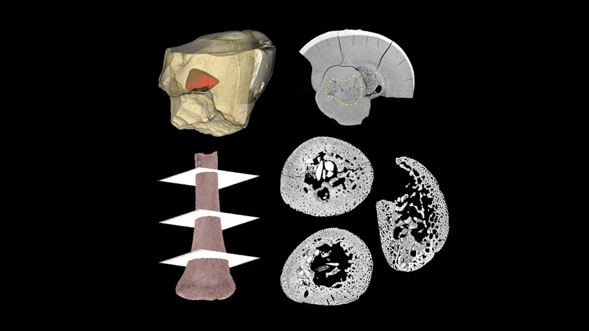 Reconstrucción tridimensional de un diente y un hueso de brazo de un neandertal: el diente muestra defectos de mineralización y el hueso revela la organización interna del tejido. (Justyna Miszkiewicz)