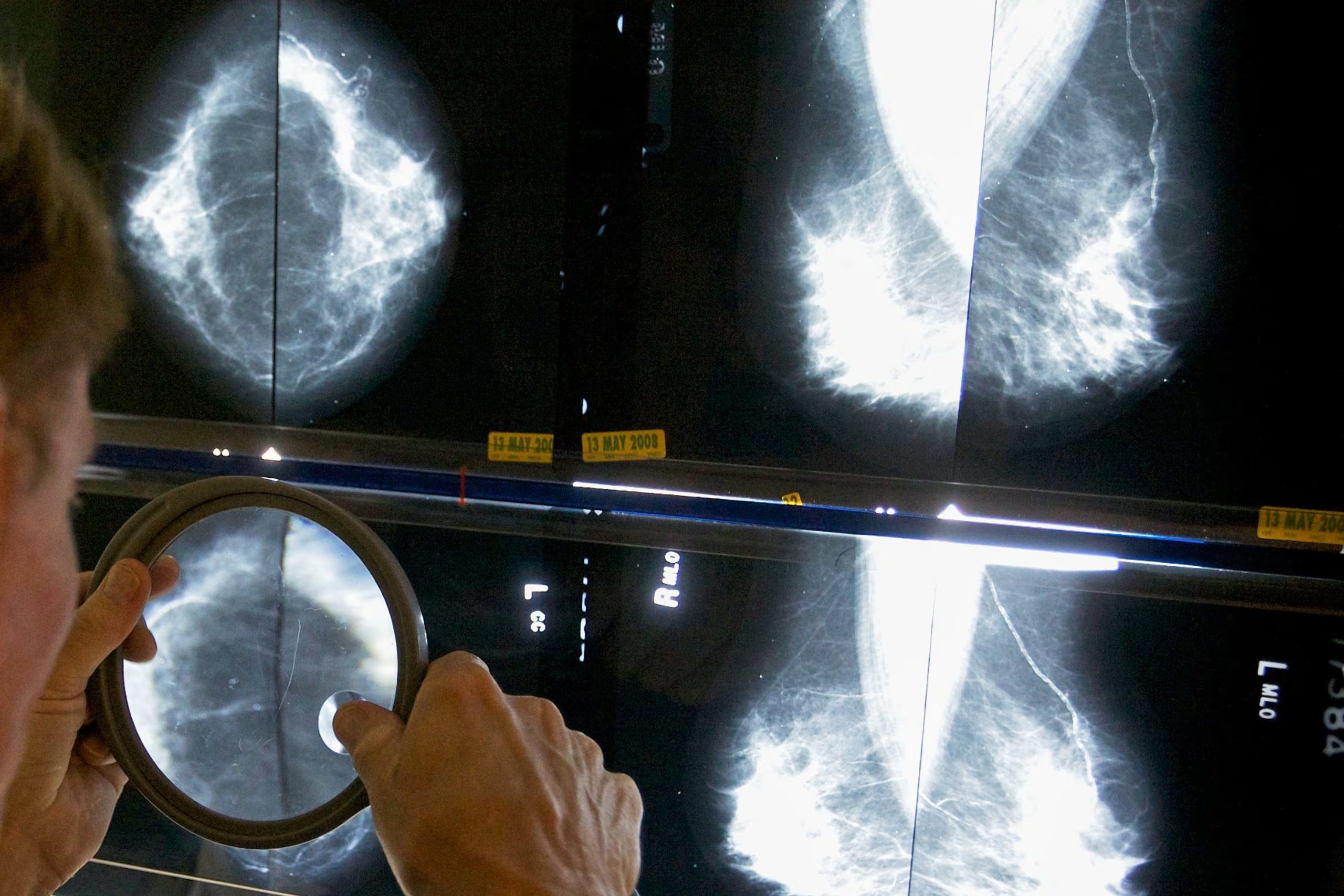 Para la hipertensión y la enfermedad coronaria, el sistema alcanzó una precisión del 79% y el 78%, respectivamente, sin importar la edad de las pacientes. (AP)