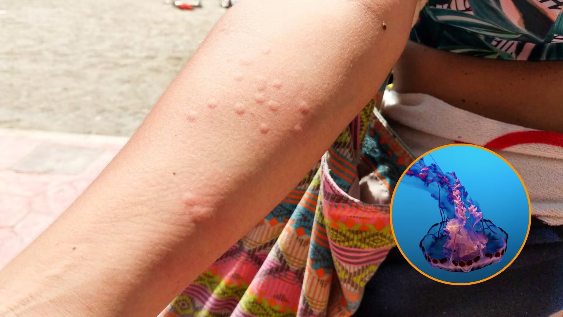 La mayoría de las picaduras de medusas no suelen ser graves (Europa Press - Víctor Manuel Mulero / Montaje Infobae)