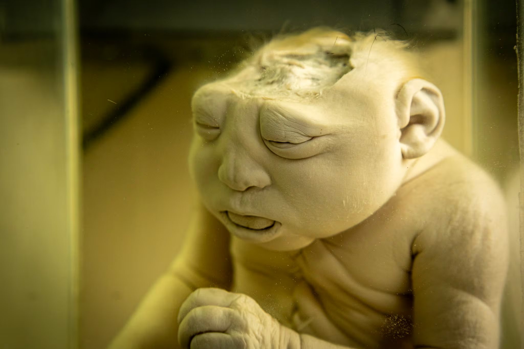 La colección incluye casos en los que el tubo neural no se cerró durante el desarrollo fetal. (Paula Elizalde)