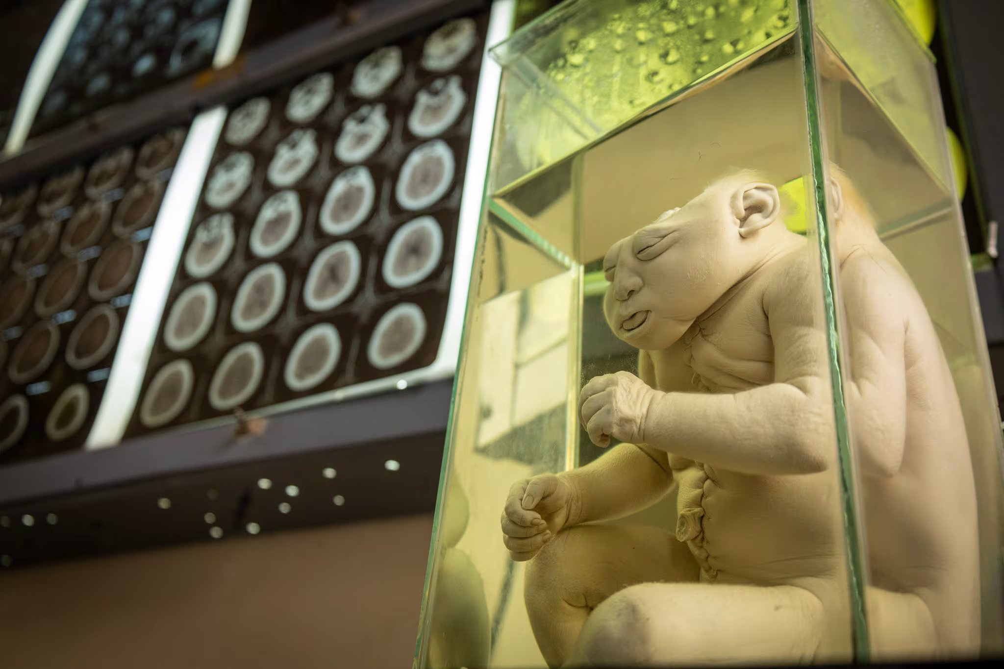 Una de las muestras permite observar un encefalocele, una malformación en la que el cerebro queda expuesto. (Paula Elizalde)