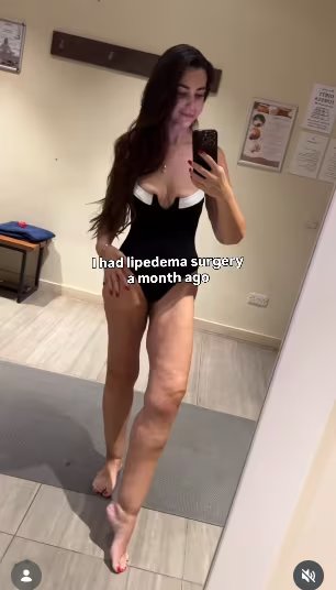 Emily también tuvo que luchar contra el lipedema, una acumulación anormal de grasa en ambos lados de la parte baja del cuerpo
(Créditos: Instagram/Emily Jones)