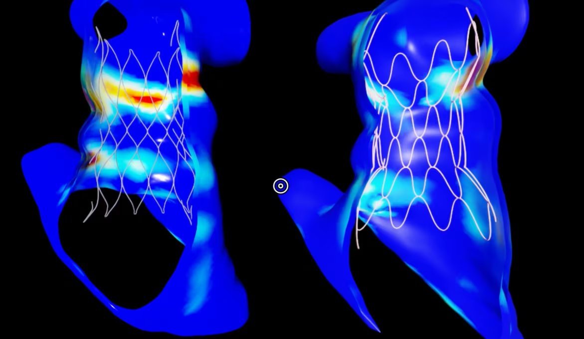 El sistema analiza tomografías, resonancias magnéticas y ecografías 3D para reconstruir la anatomía cardíaca pediátrica. (Nvidia)