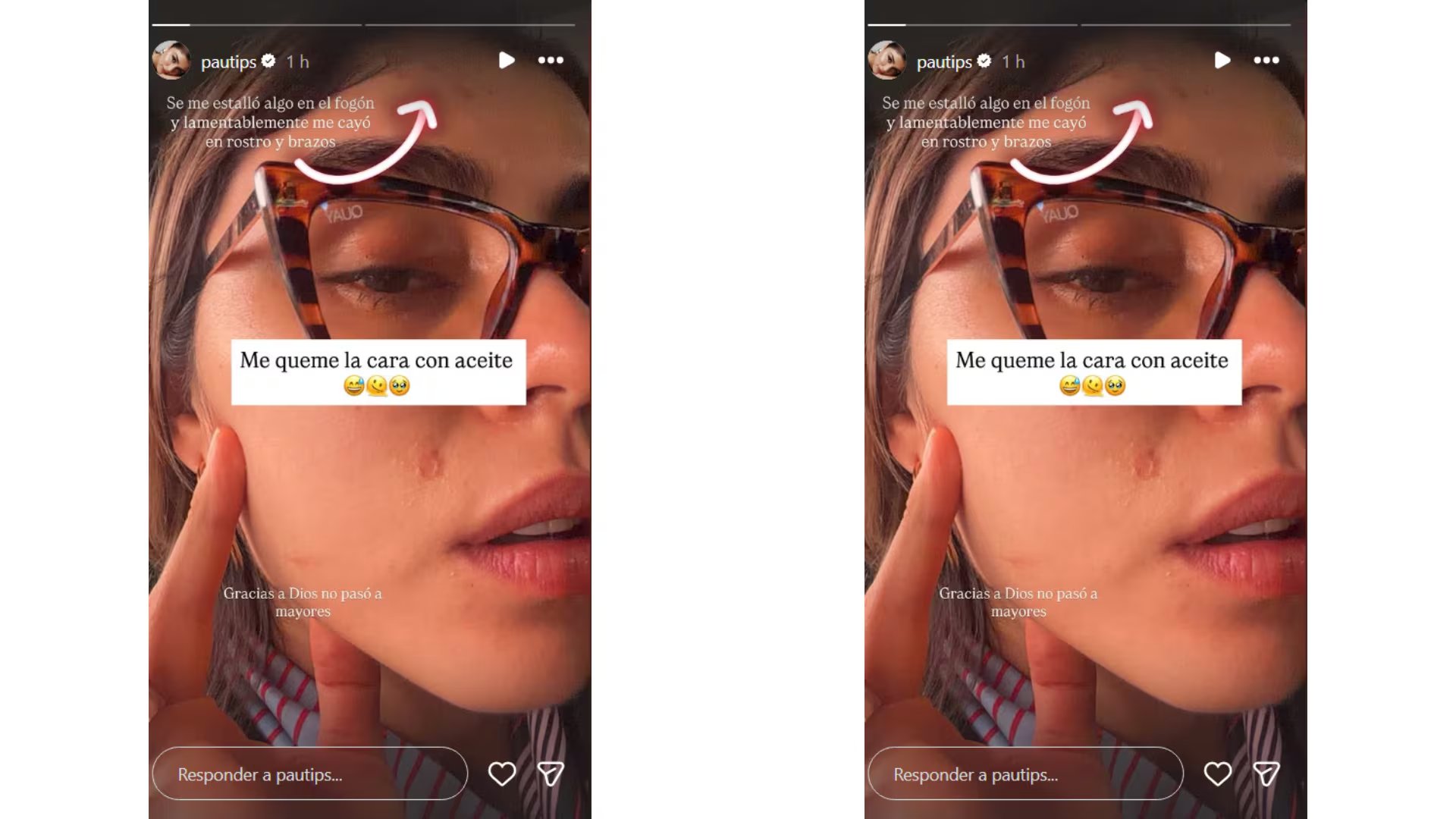 Pautips mostró en redes sociales las quemaduras que sufrió en el rostro y los brazos durante las grabaciones de Masterchef Celebrity - crédito @pautips/ Instagram
