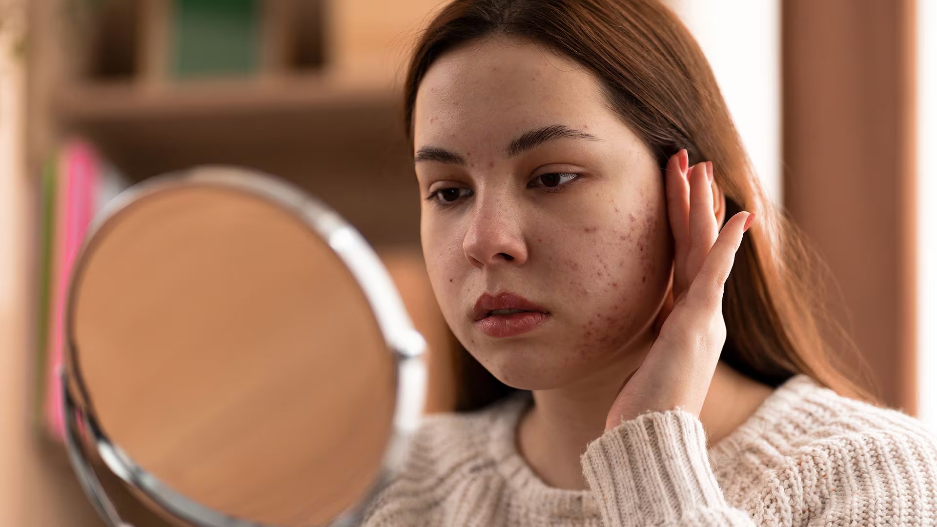 La dermatitis de contacto irritativa figuró como la afección más frecuente entre las personas afectadas por seguir tendencias virales de cuidado facial. (Freepik)